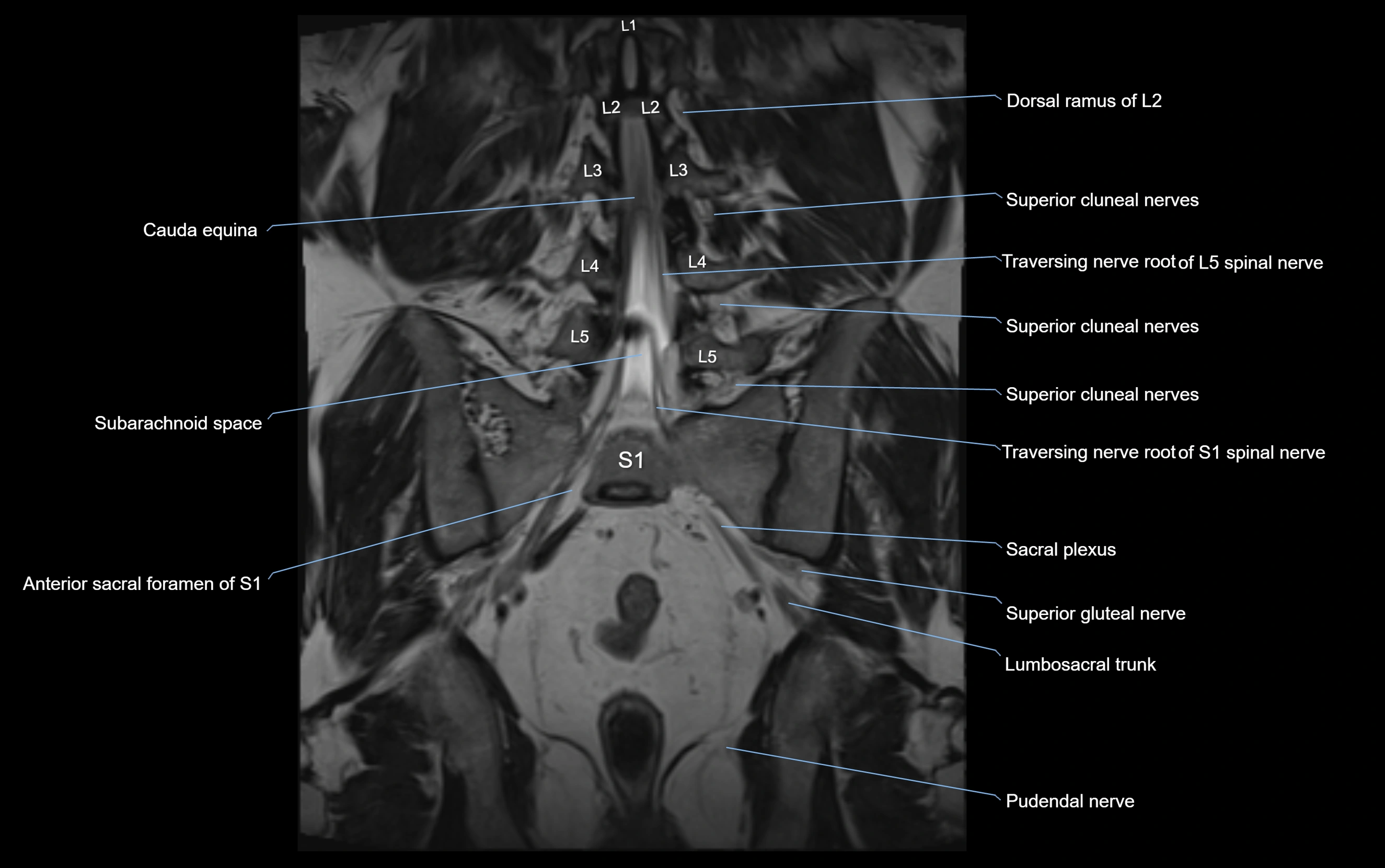 MR lumbosacral plexus cross sectional anatomy 3T  radiology  image-img-09001-00045.webp